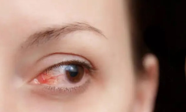 التهاب العين نتيجة مرض بهجت
