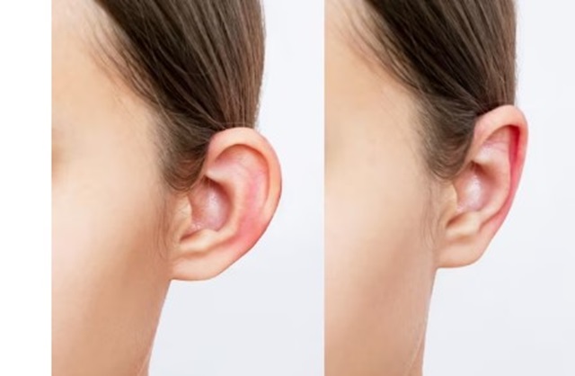جراحة تصحيح شكل الأذن