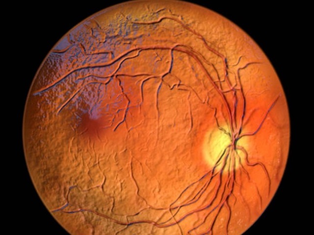  علاج شبكية العين