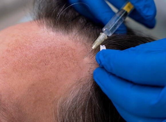 ابتكارات وآفاق زراعة الشعر في المانيا