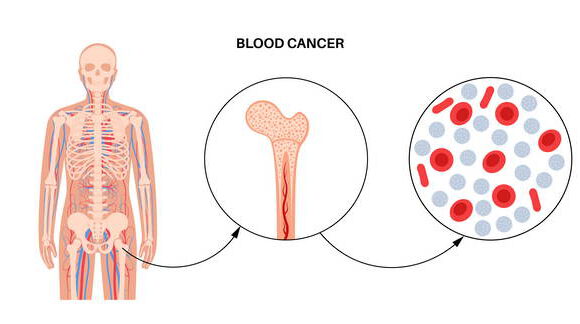 تفوق باهر في علاج المايلوما في ألمانيا